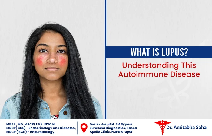 What Is Lupus
