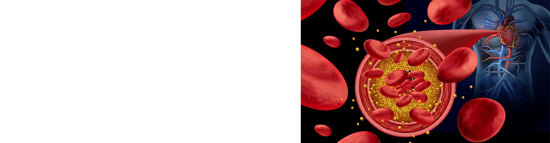 high cholesterol treatment