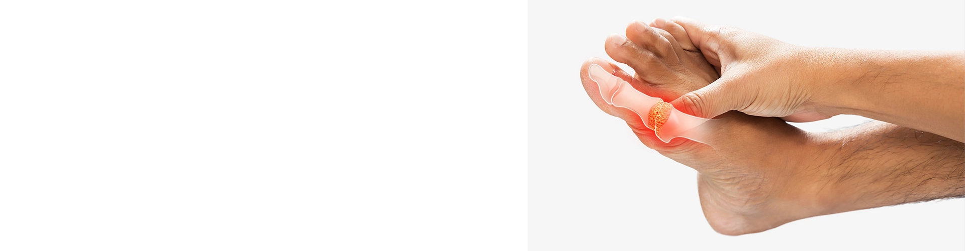 High Uric Acid Treatment